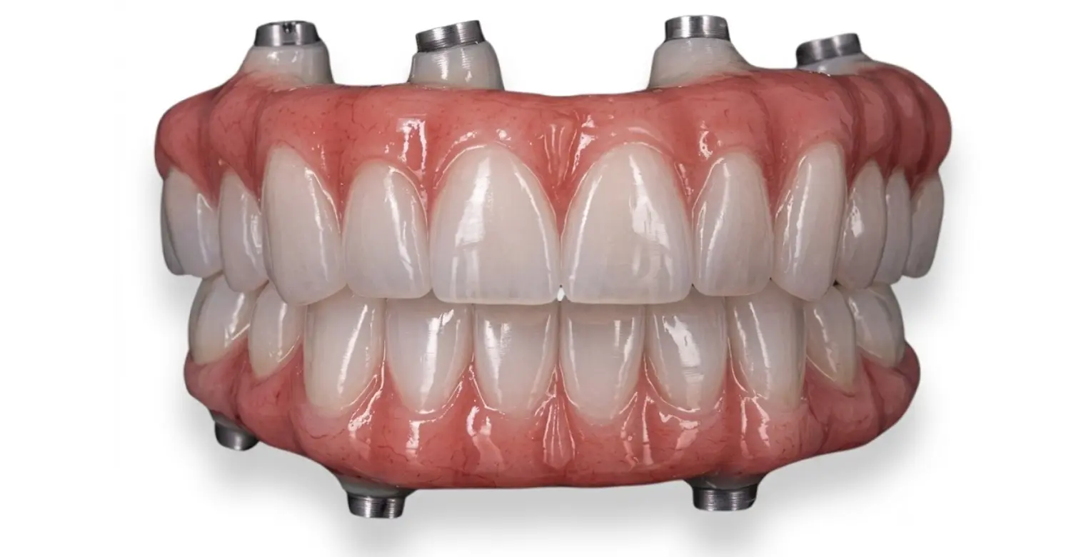 Full Mouth Dental Implants Cost 2